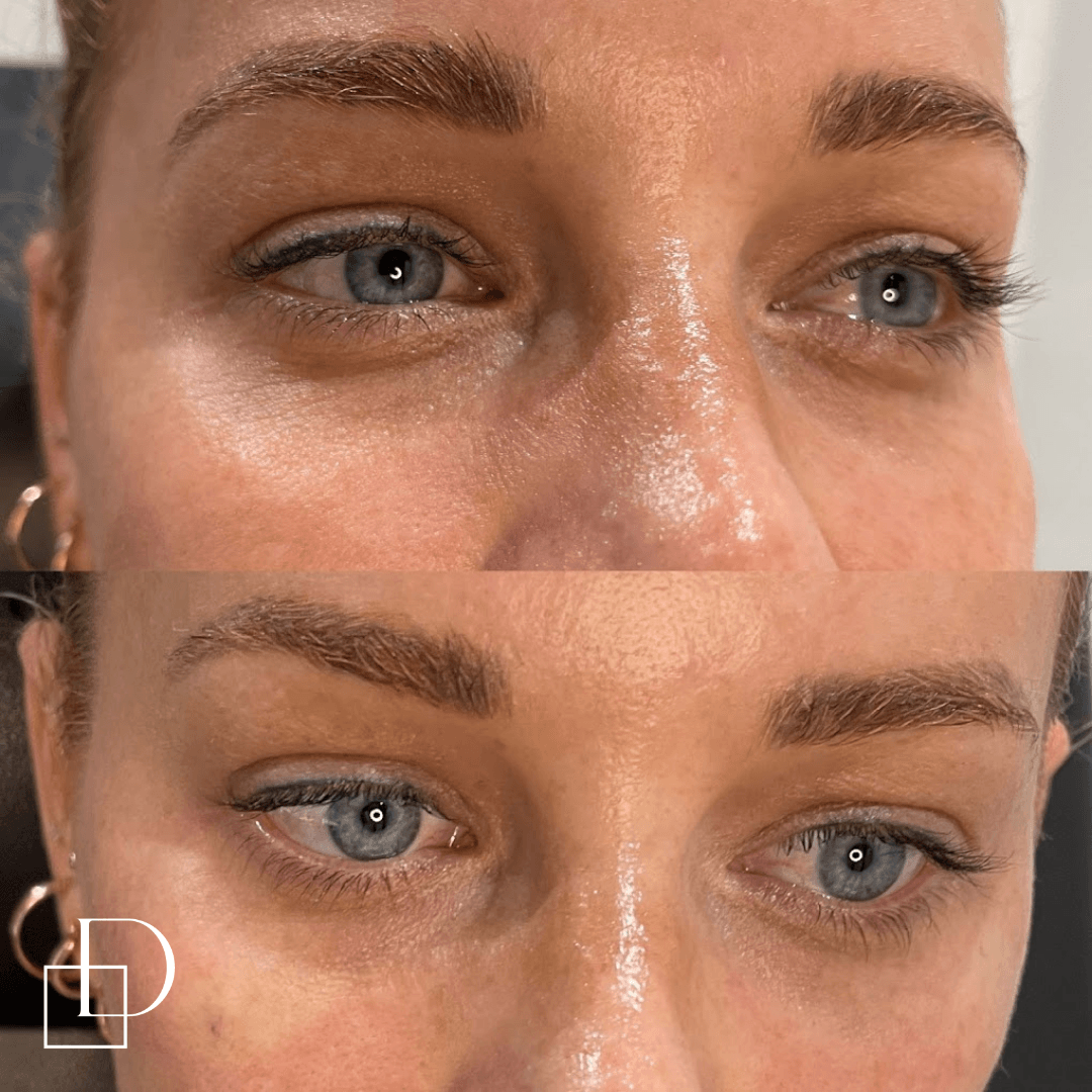 Before and after tear trough under eye filler injections at Define Clinic Brisbane
