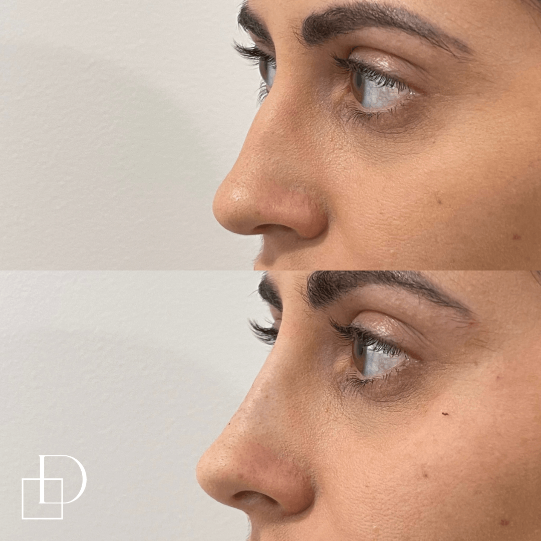 Before and after non-surgical rhinoplasty nose filler at Define Clinic Brisbane