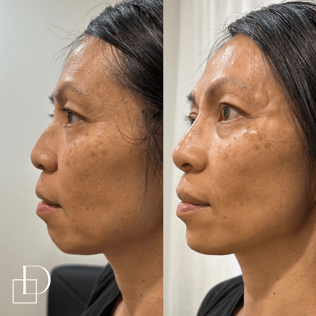 Before and after chin filler injections at Define Clinic Brisbane