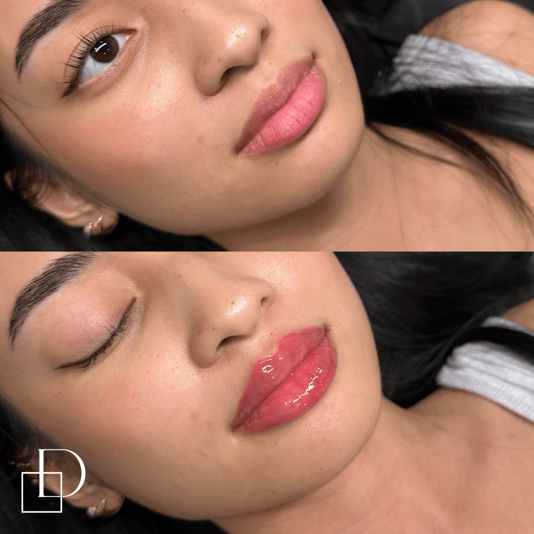 Before and after lip filler injections at Define Clinic Brisbane