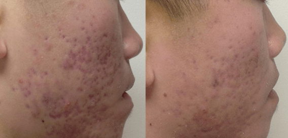 Before and after acne treatment with Laser Genesis at Define Clinic Brisbane