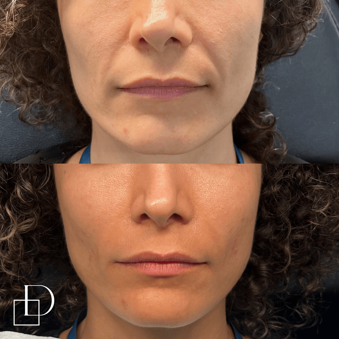 Before and after cosmetic dermal filler injections at Define Clinic Brisbane