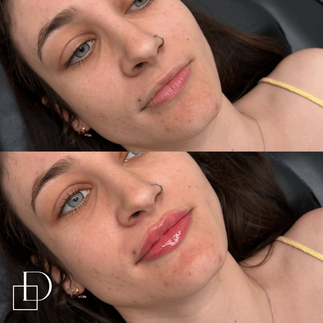 Before and after lip filler injections at Define Clinic Brisbane