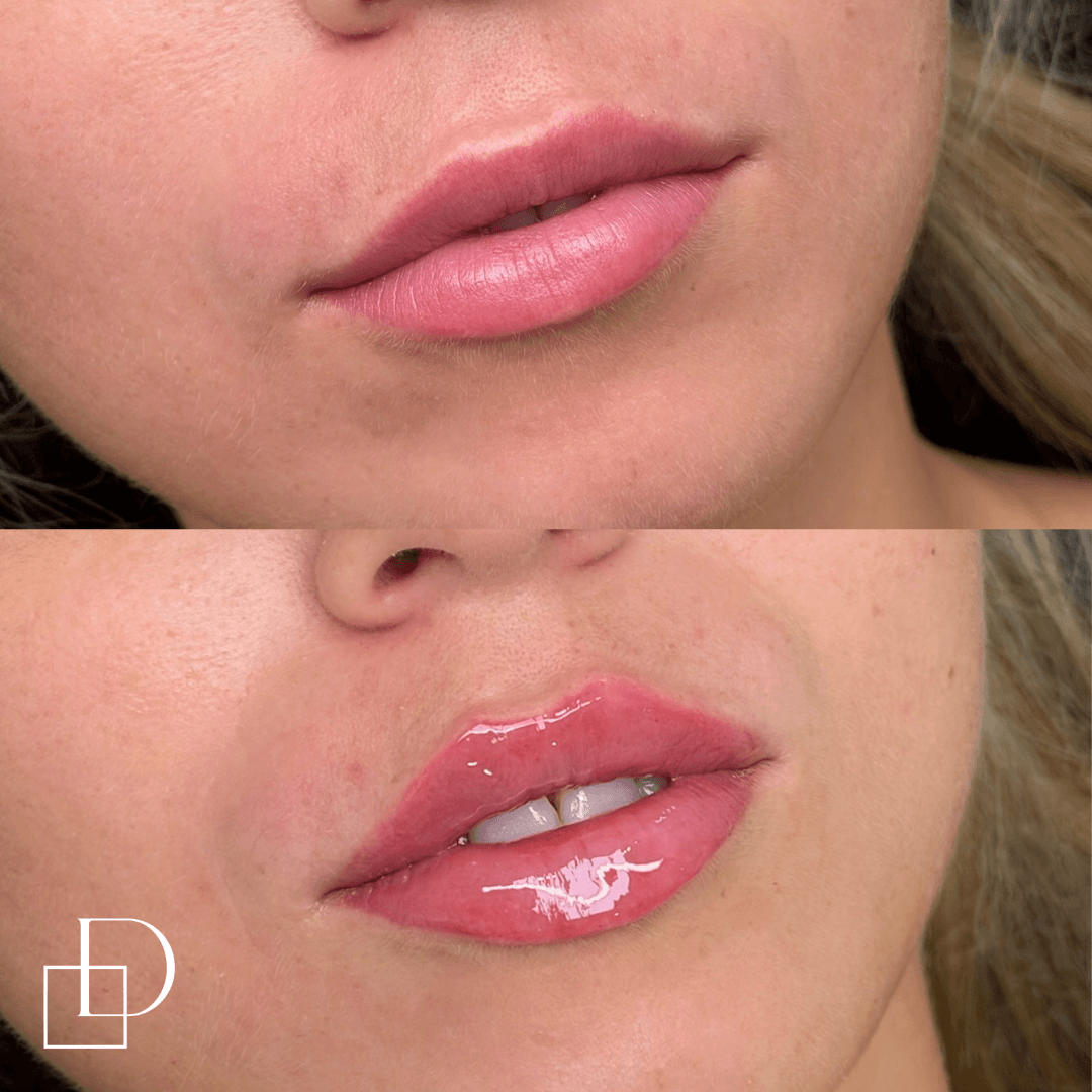 Before and after lip filler injections at Define Clinic Brisbane
