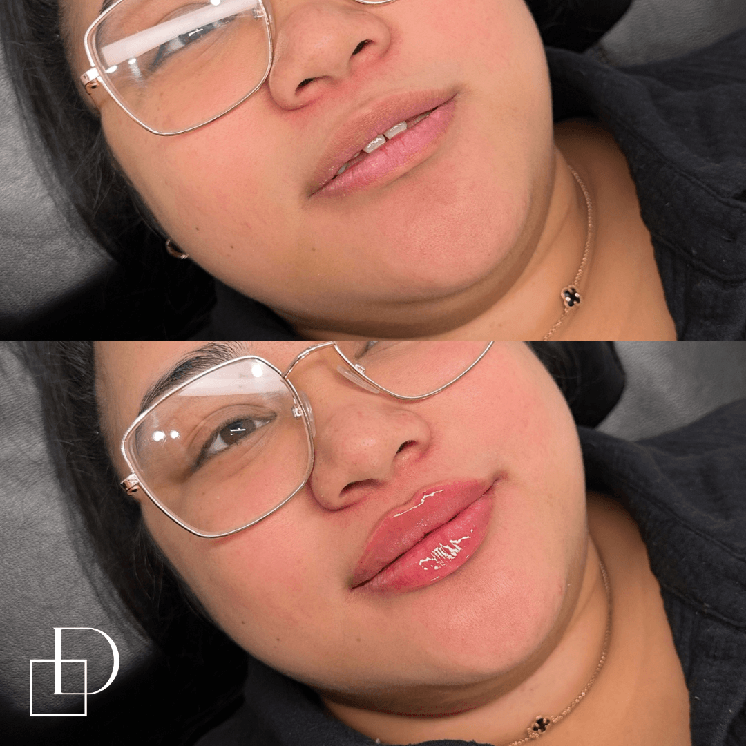 Before and after lip filler injections at Define Clinic Brisbane