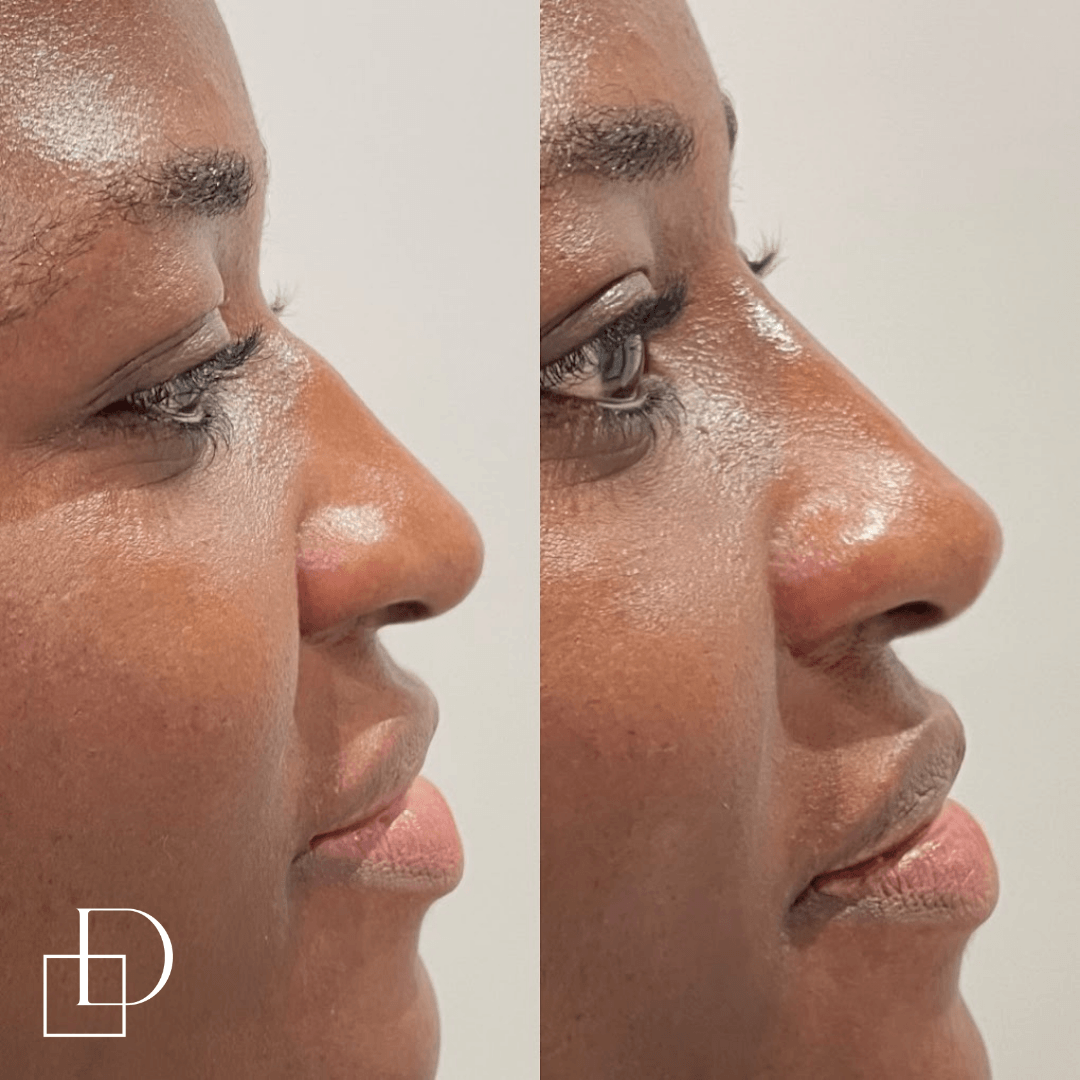 Before and after non-surgical rhinoplasty nose filler at Define Clinic Brisbane