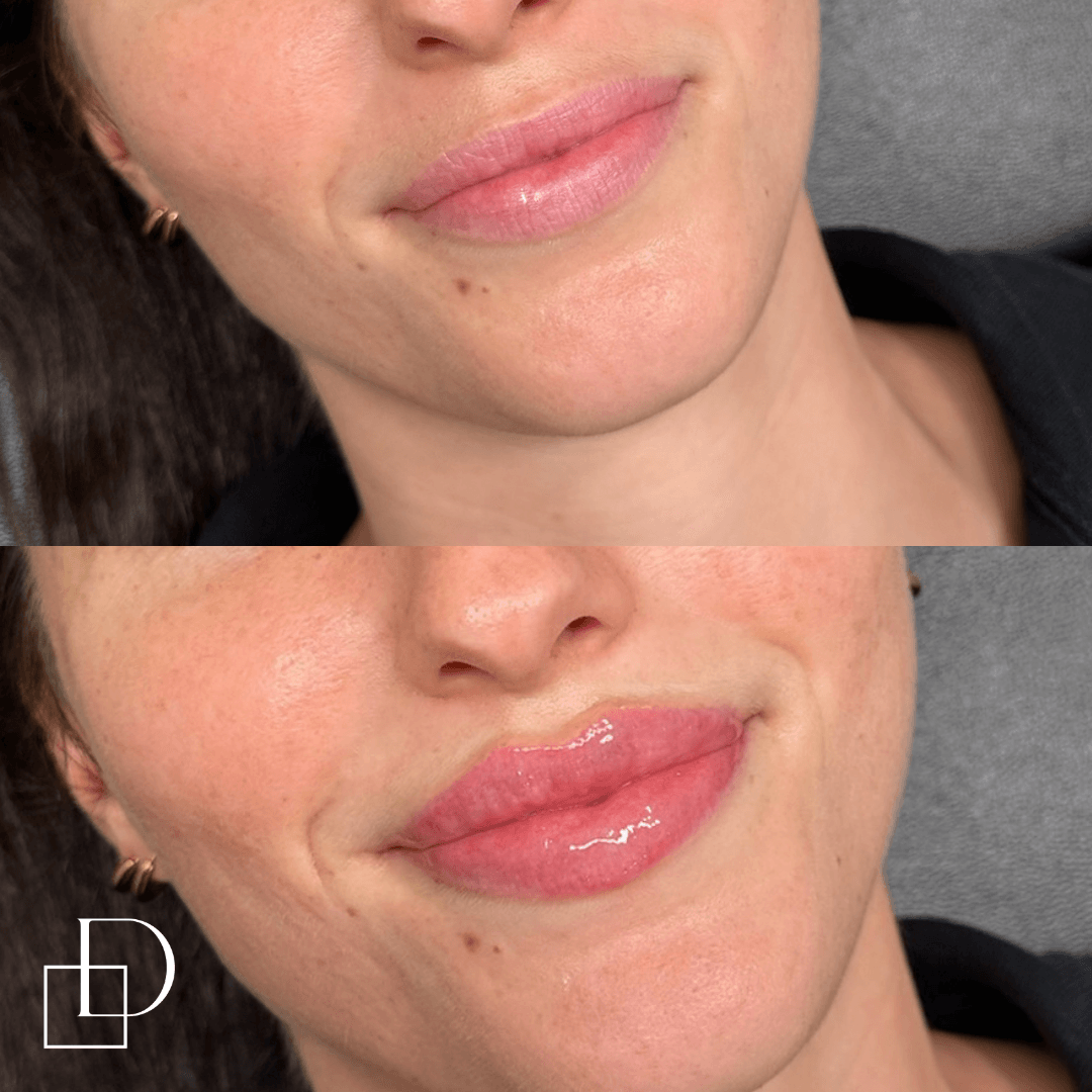 Before and after lip filler injections at Define Clinic Brisbane