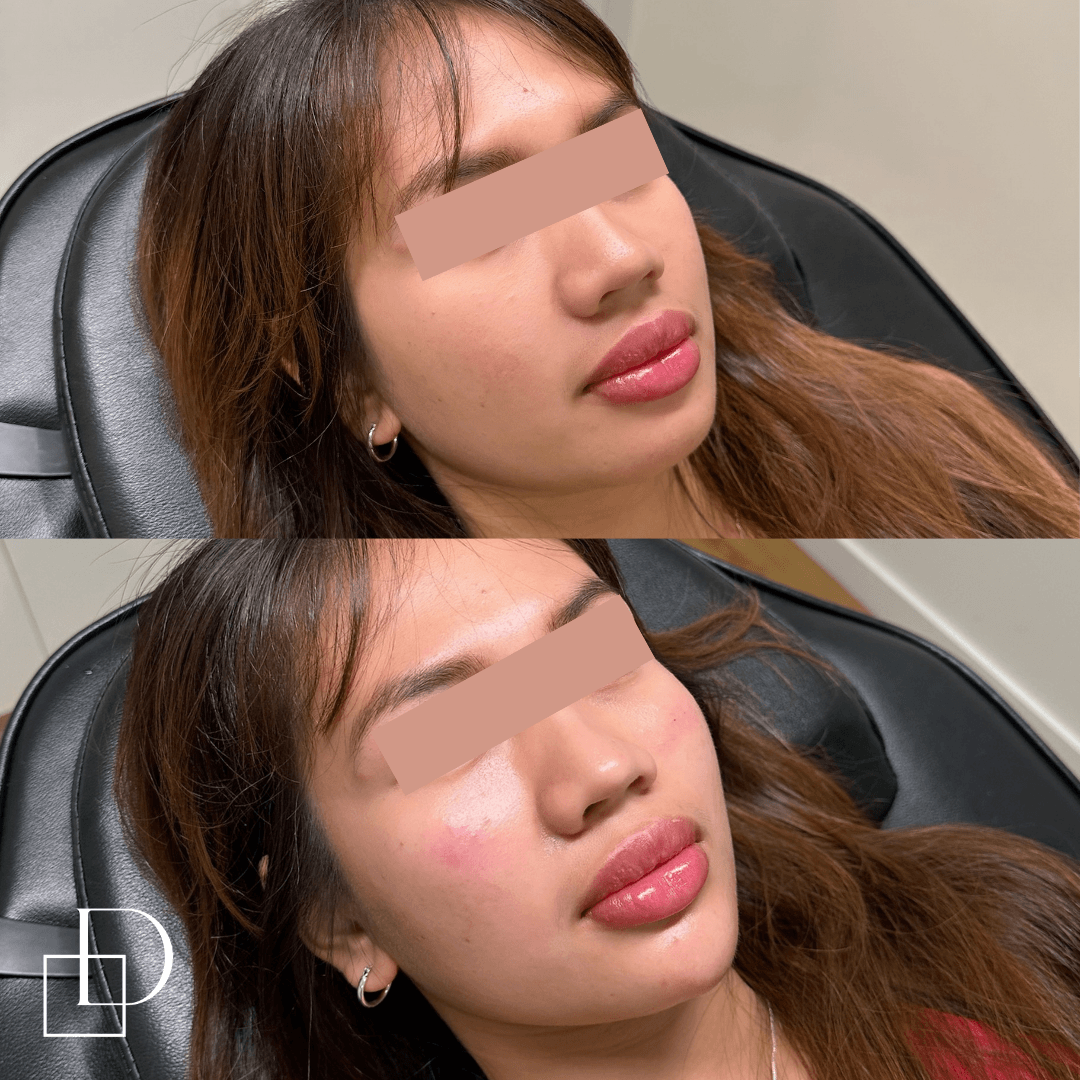 Before and after chin filler injections at Define Clinic Brisbane