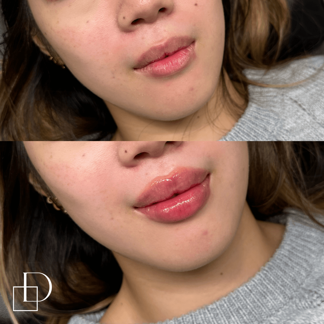 Before and after lip filler injections at Define Clinic Brisbane