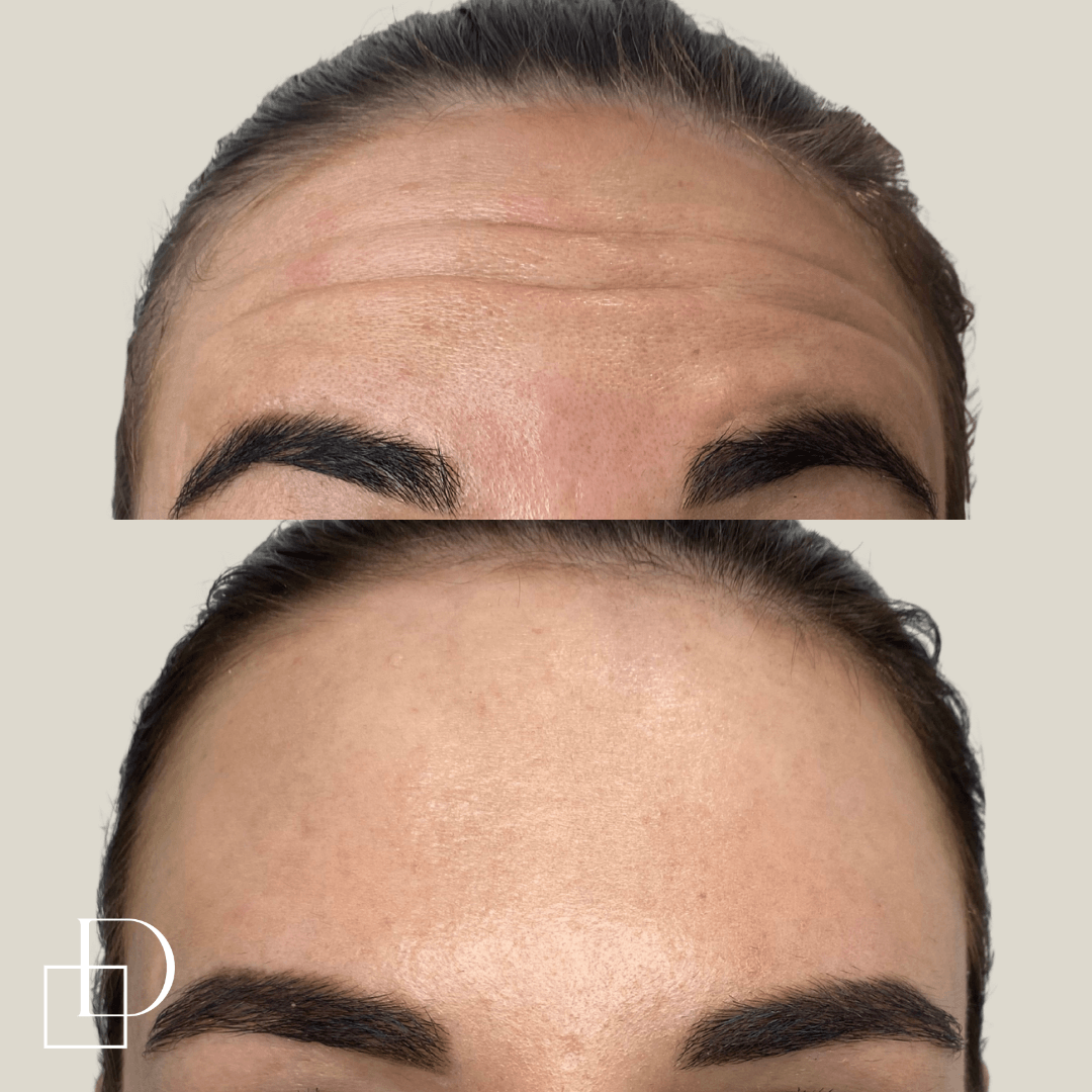 Before and after forehead botox anti-wrinkle at Define Clinic Brisbane