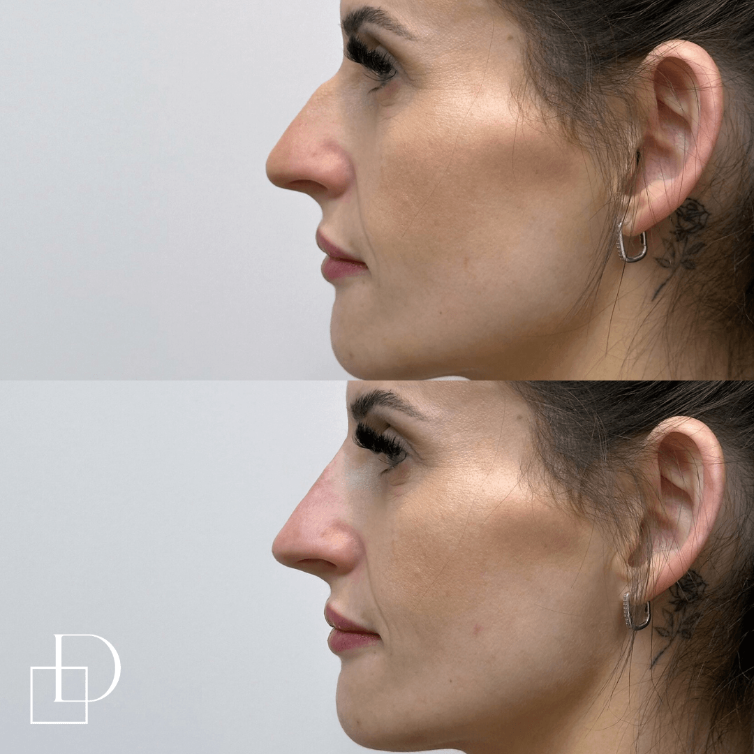 Before and after non-surgical rhinoplasty nose filler at Define Clinic Brisbane