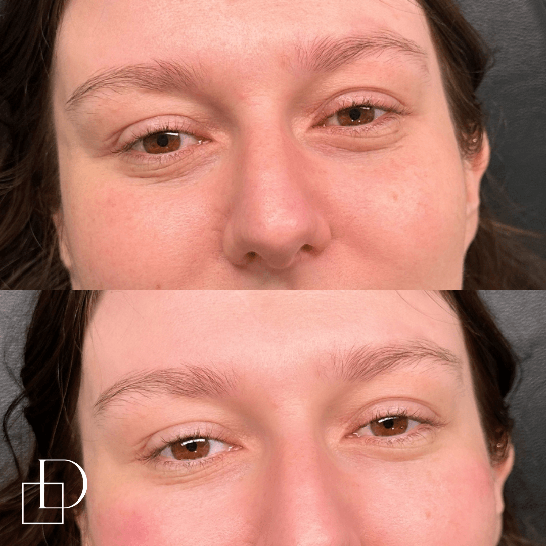 Before and after tear trough under eye filler injections at Define Clinic Brisbane