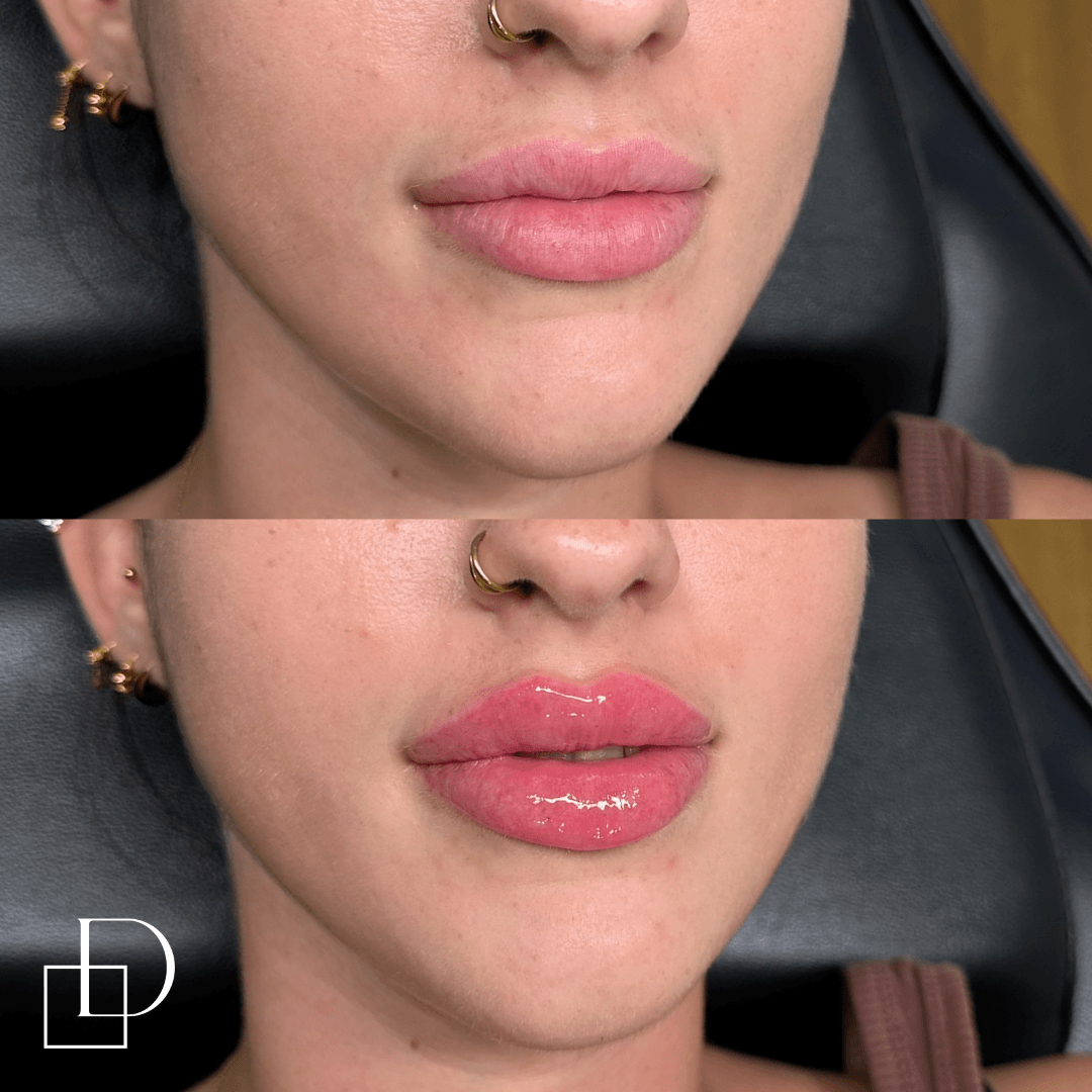 Before and after lip filler injections at Define Clinic Brisbane
