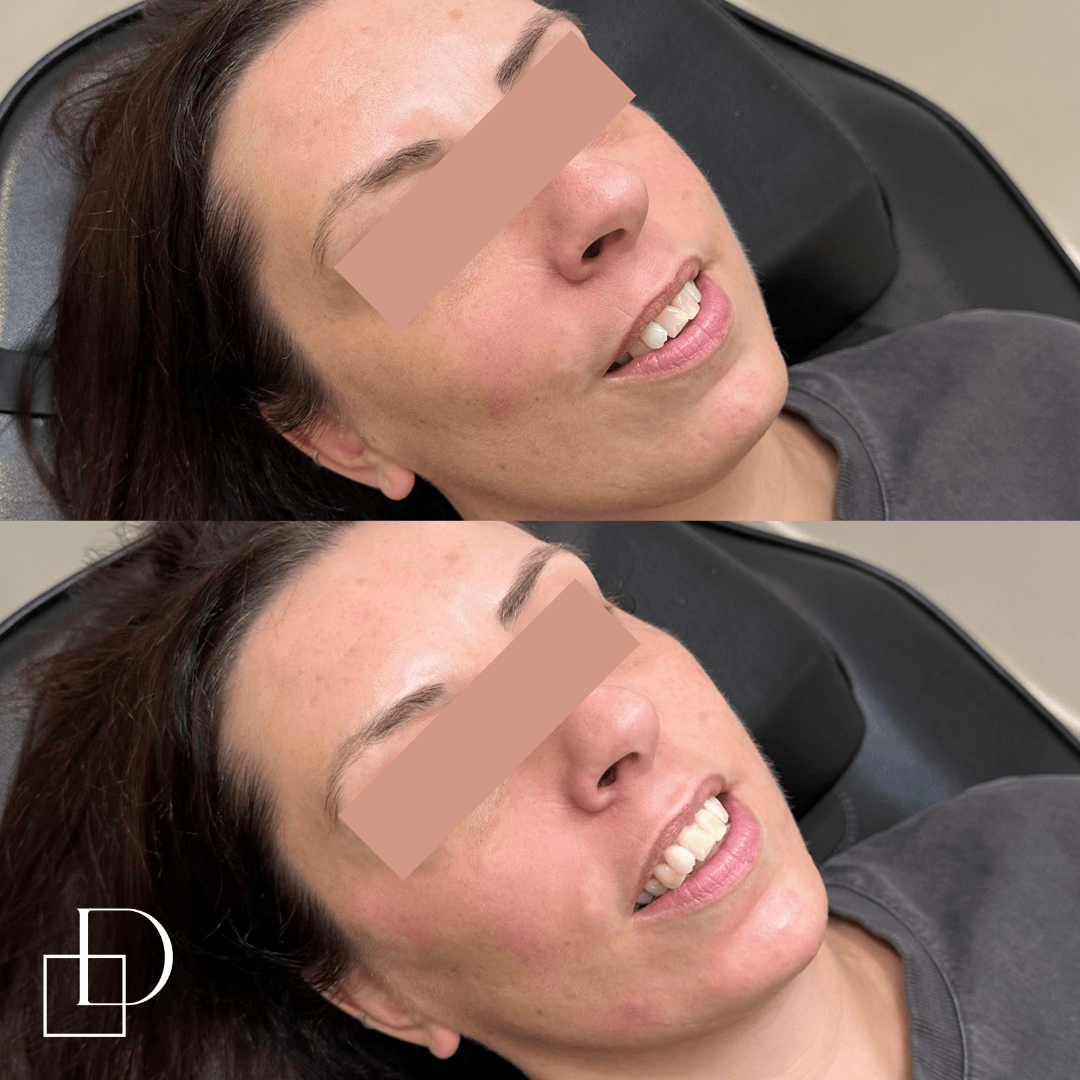 Before and after chin filler injections at Define Clinic Brisbane
