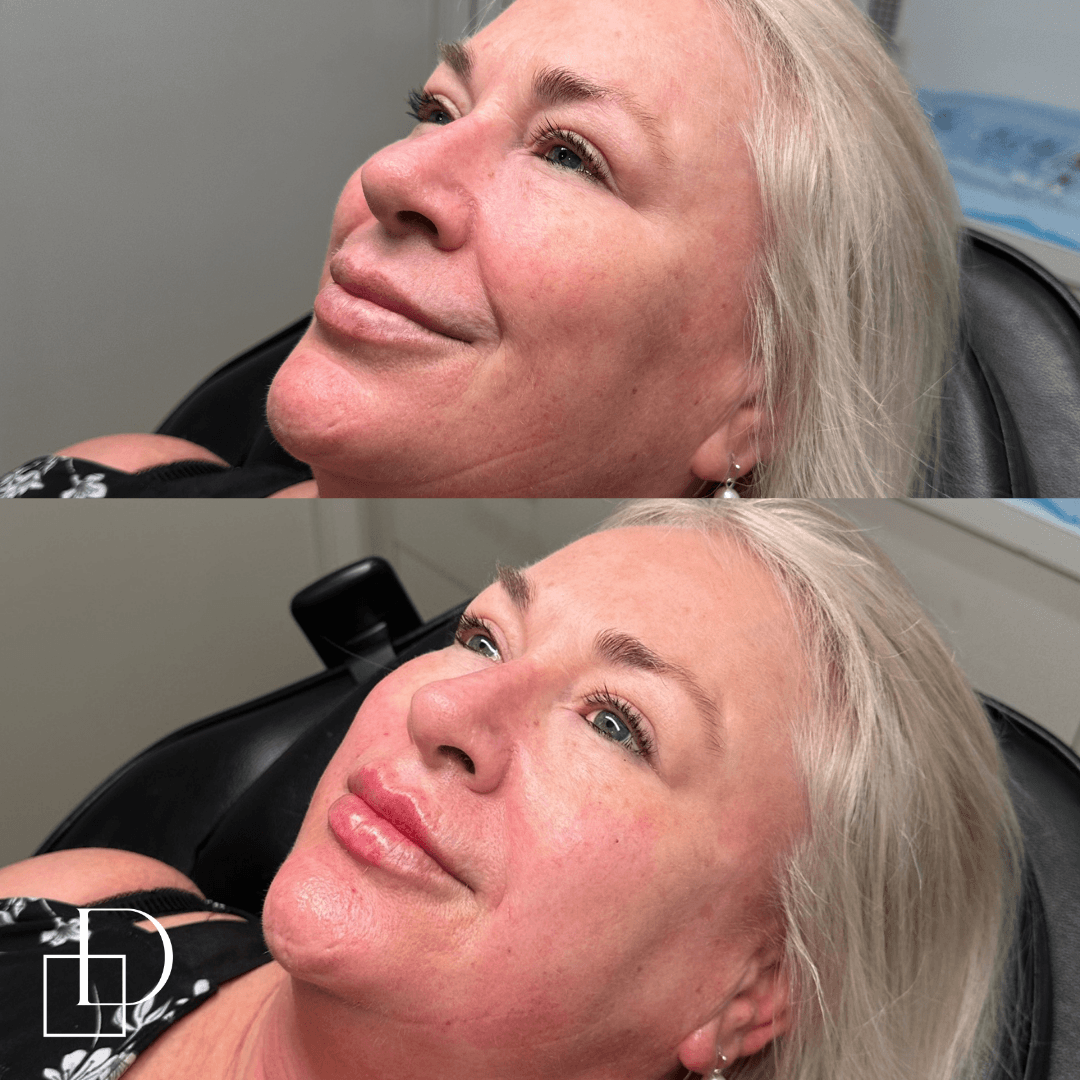 Before and after cosmetic dermal filler injections at Define Clinic Brisbane