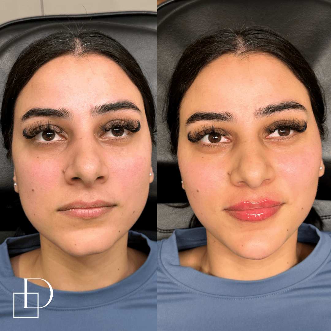 Before and after lip, chin and cheek filler injections at Define Clinic Brisbane