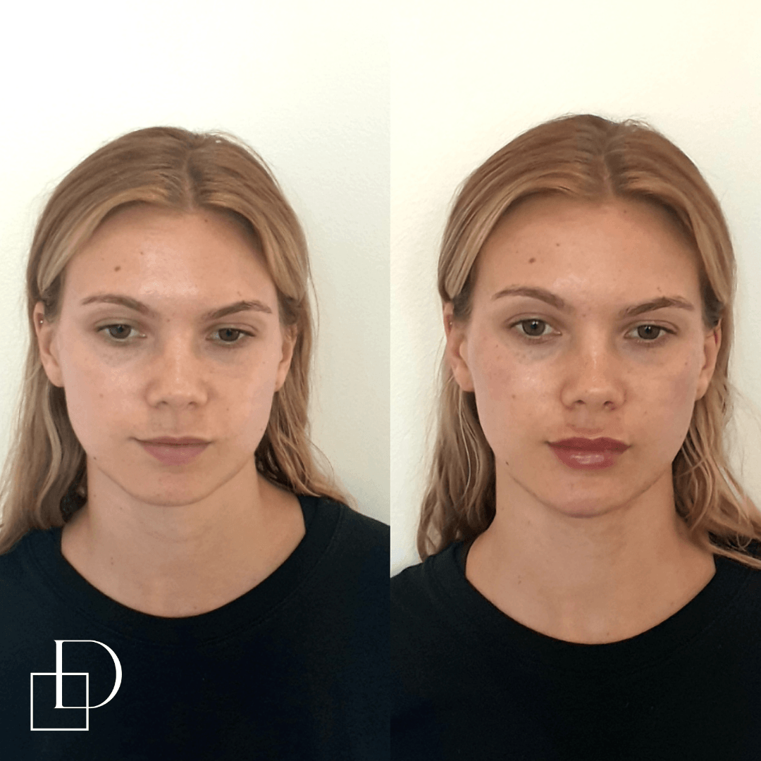 Before and after cheek filler injections at Define Clinic Brisbane