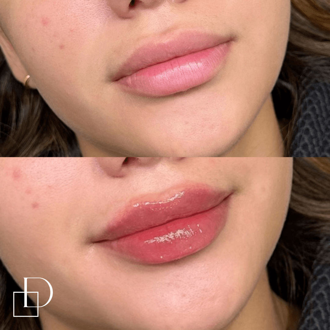Before and after lip filler injections at Define Clinic Brisbane