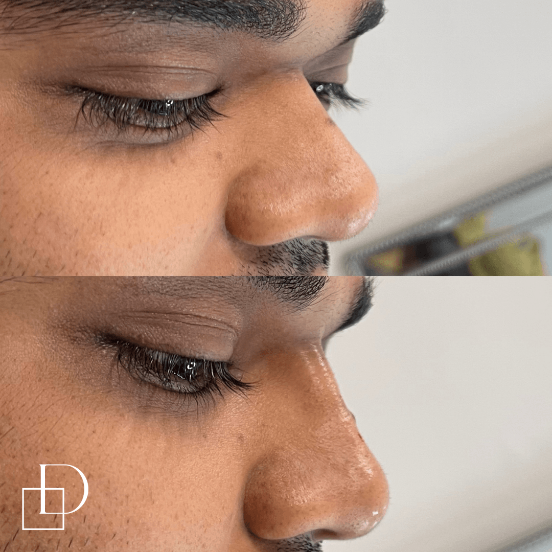 Before and after non-surgical rhinoplasty nose filler at Define Clinic Brisbane