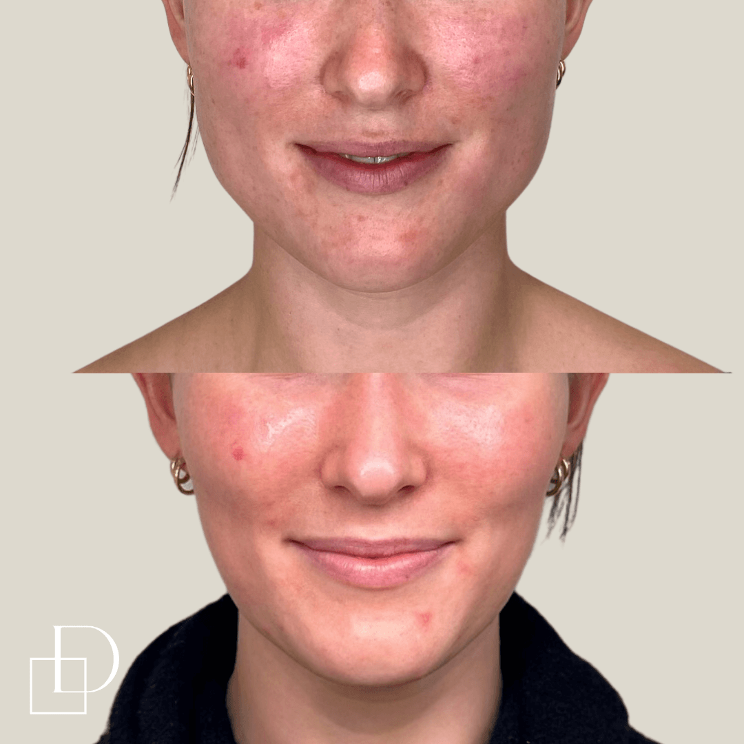 Before and after masseters botox at Define Clinic Brisbane