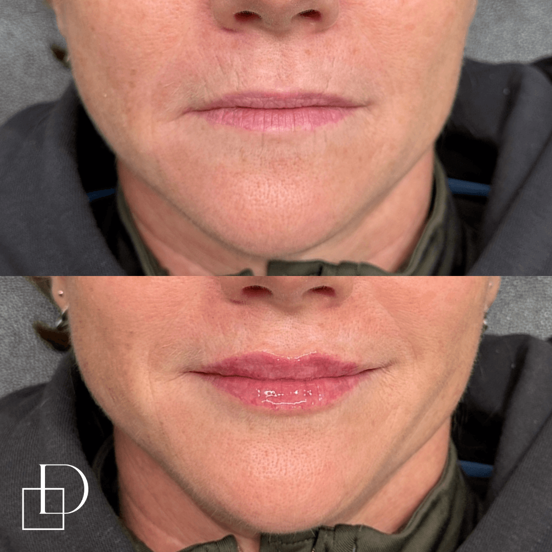 Before and after lip filler injections at Define Clinic Brisbane