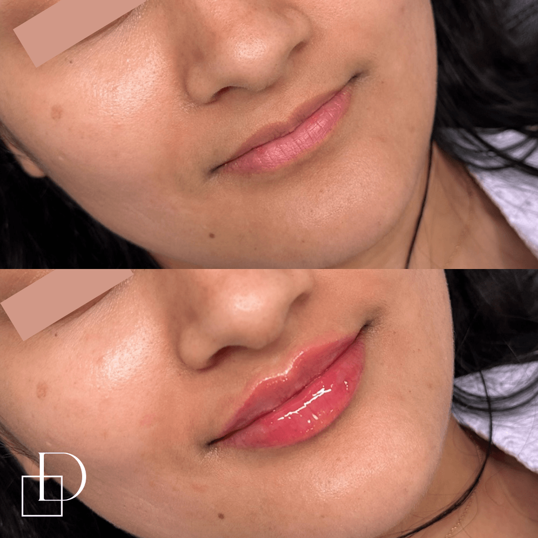 Before and after lip filler injections at Define Clinic Brisbane