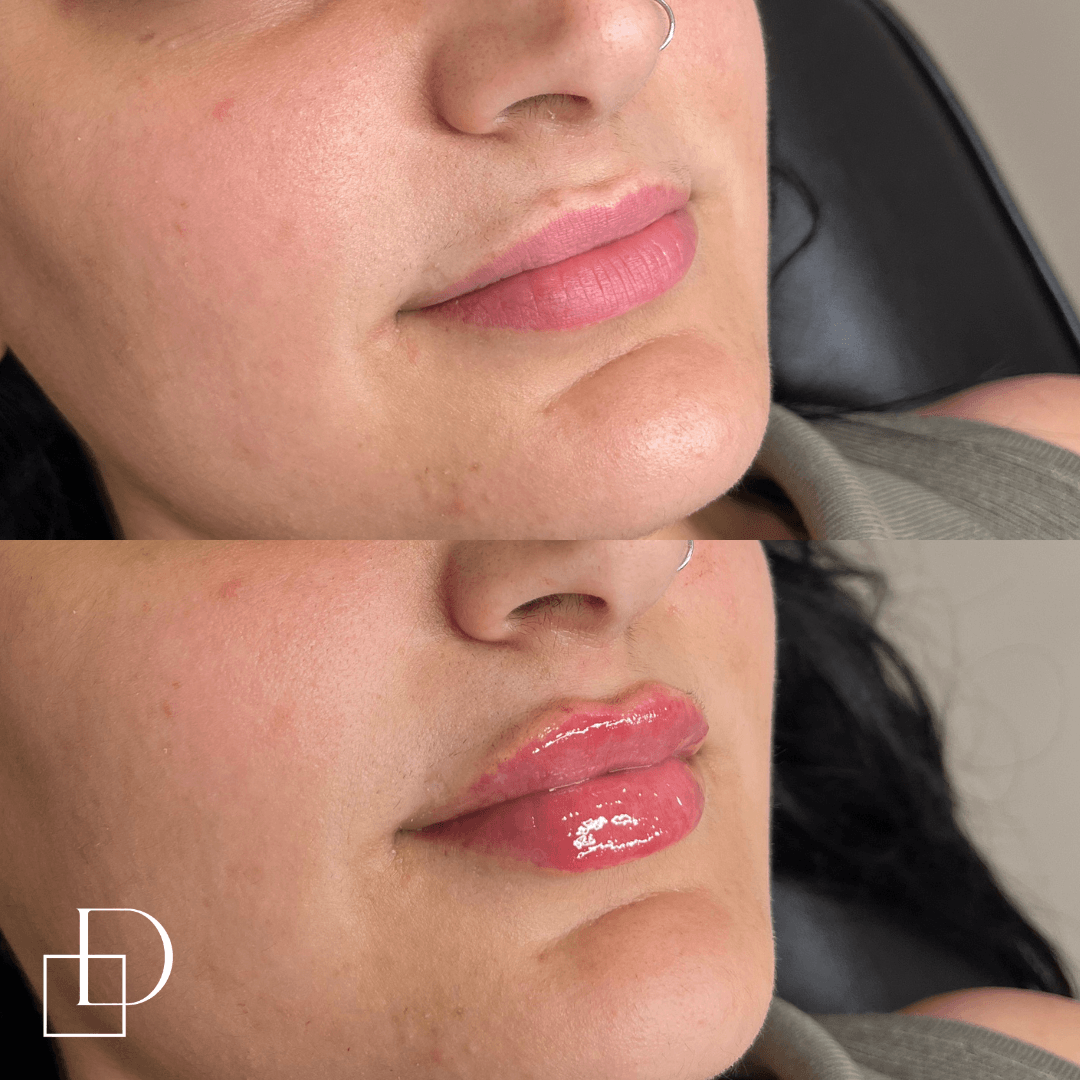Before and after lip filler injections at Define Clinic Brisbane