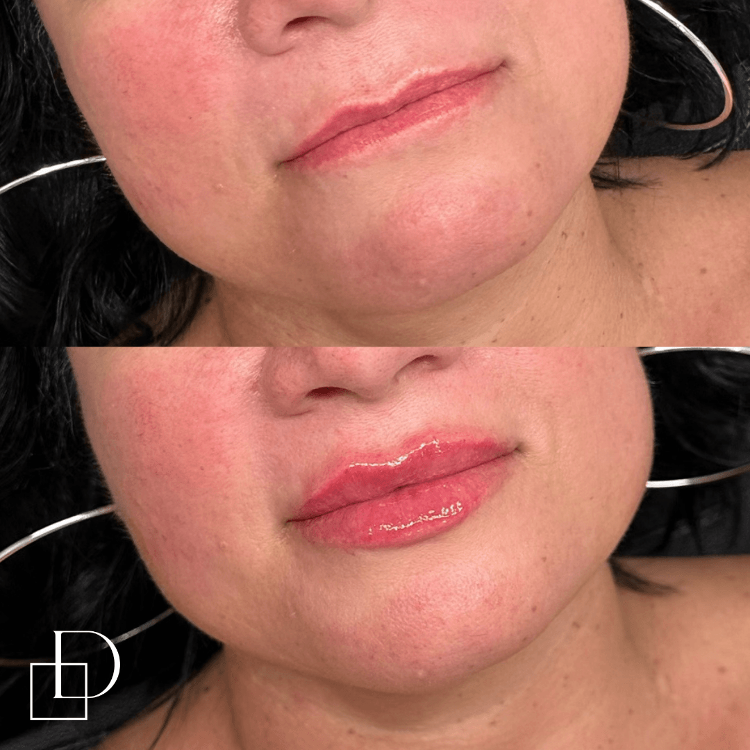 Before and after lip filler injections at Define Clinic Brisbane