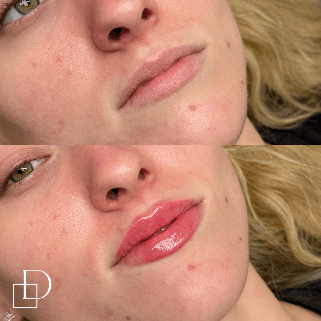 Before and after lip filler injections at Define Clinic Brisbane
