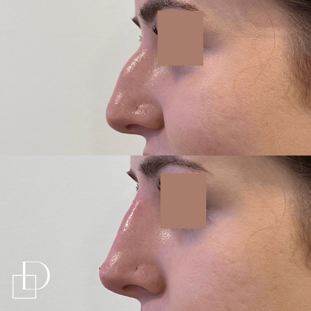 Before and after non-surgical rhinoplasty nose filler at Define Clinic Brisbane