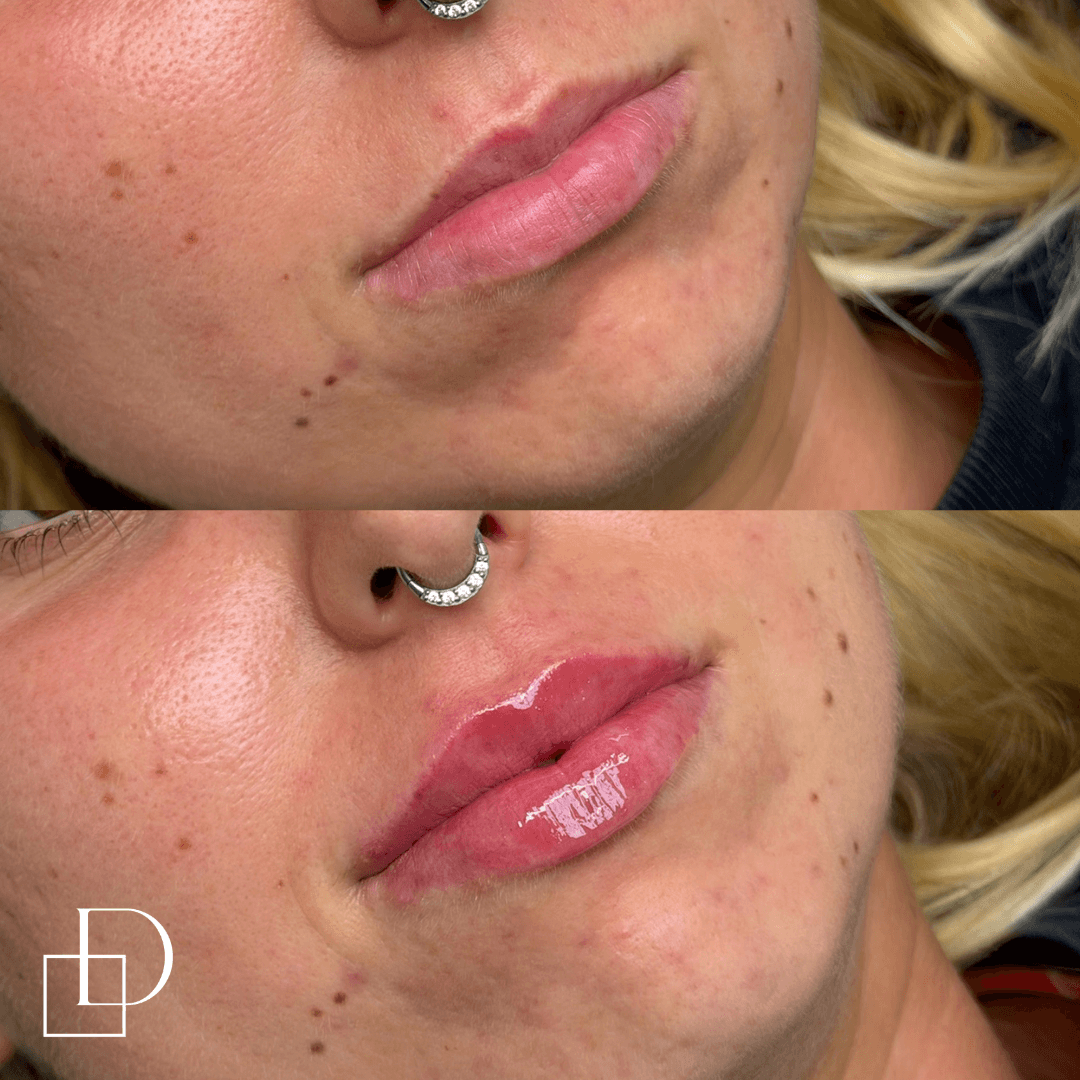 Before and after lip filler injections at Define Clinic Brisbane