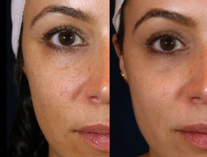 Before and after acne treatment with Laser Genesis at Define Clinic Brisbane