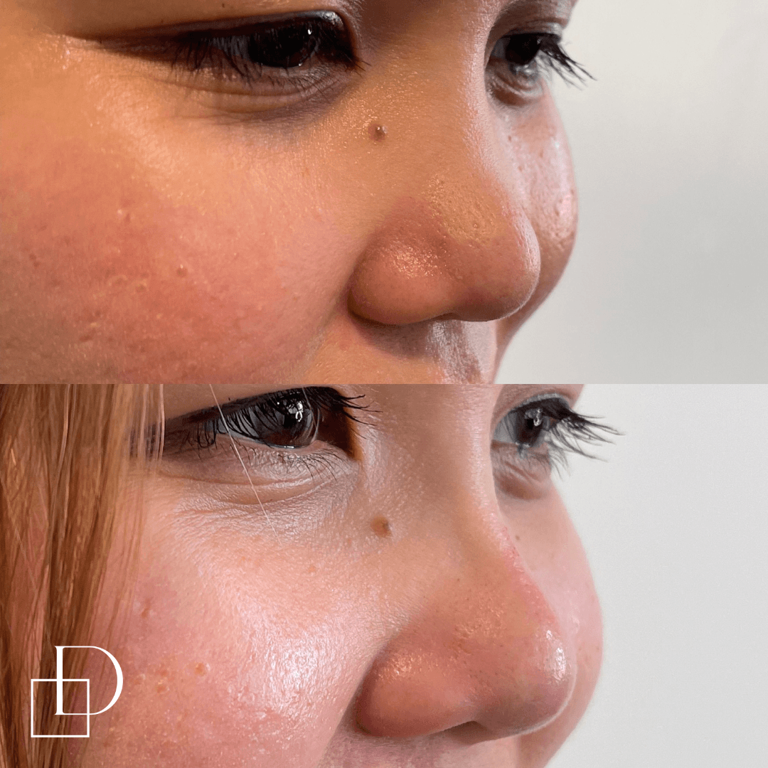 Before and after non-surgical rhinoplasty nose filler at Define Clinic Brisbane