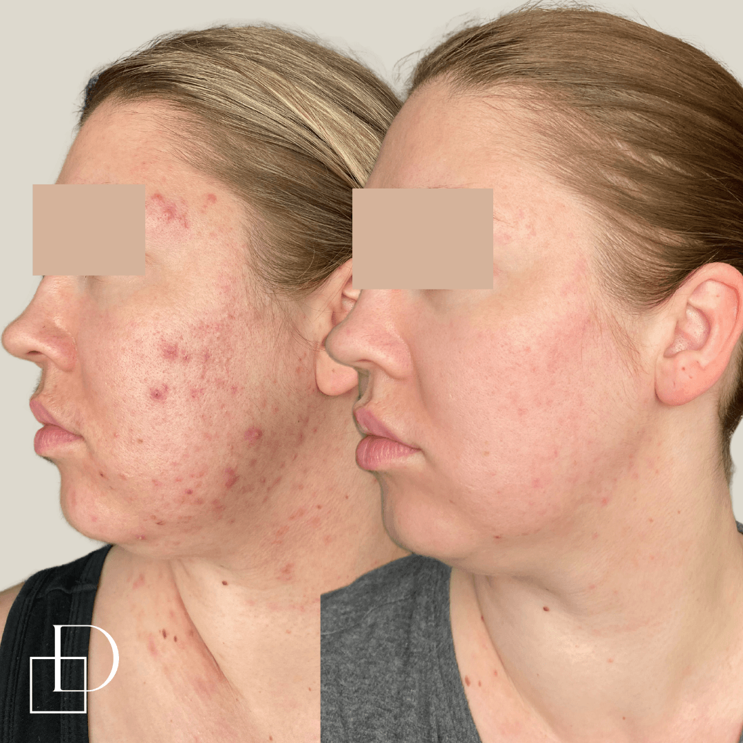 Before and after acne treatment with Laser Genesis at Define Clinic Brisbane