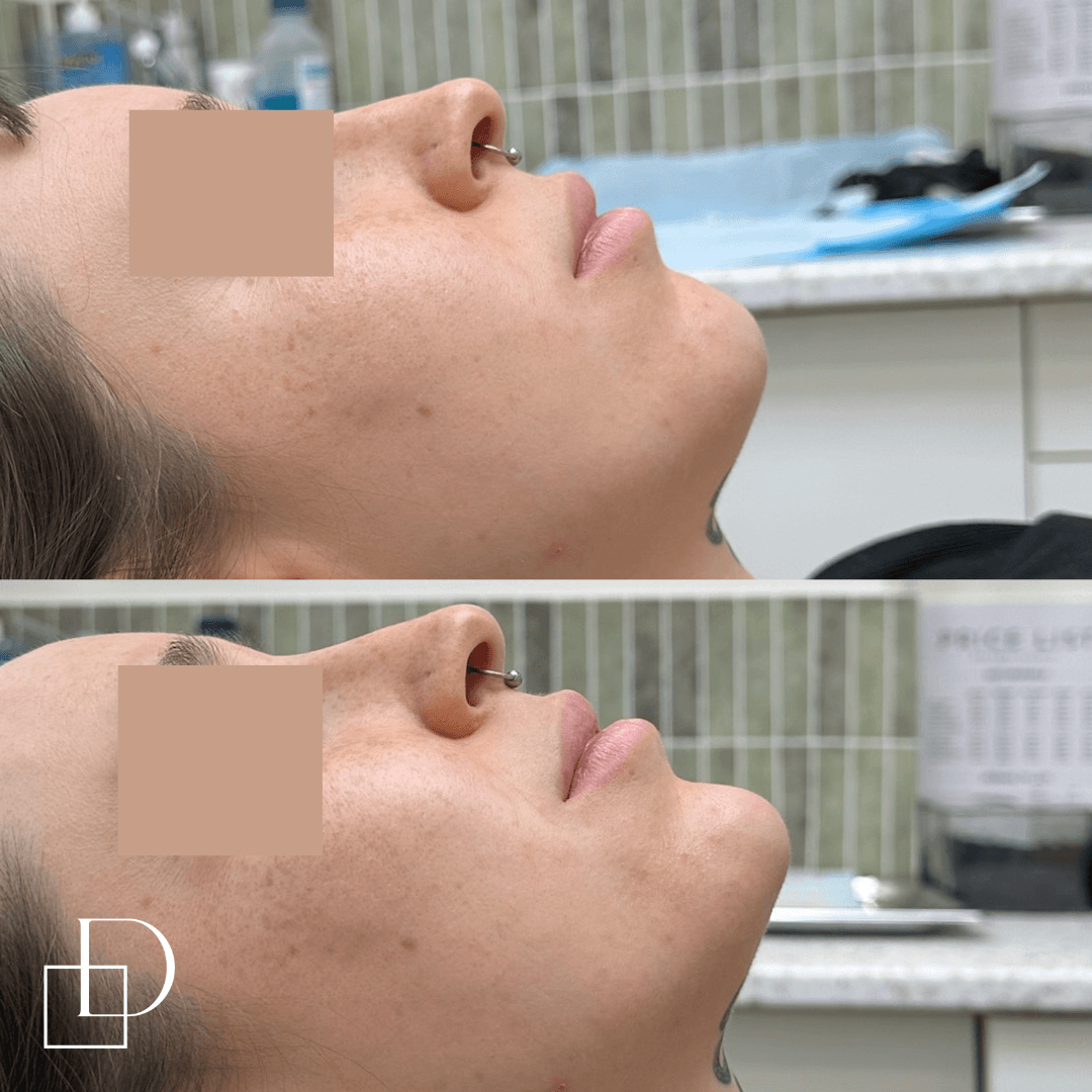 Before and after chin filler injections at Define Clinic Brisbane