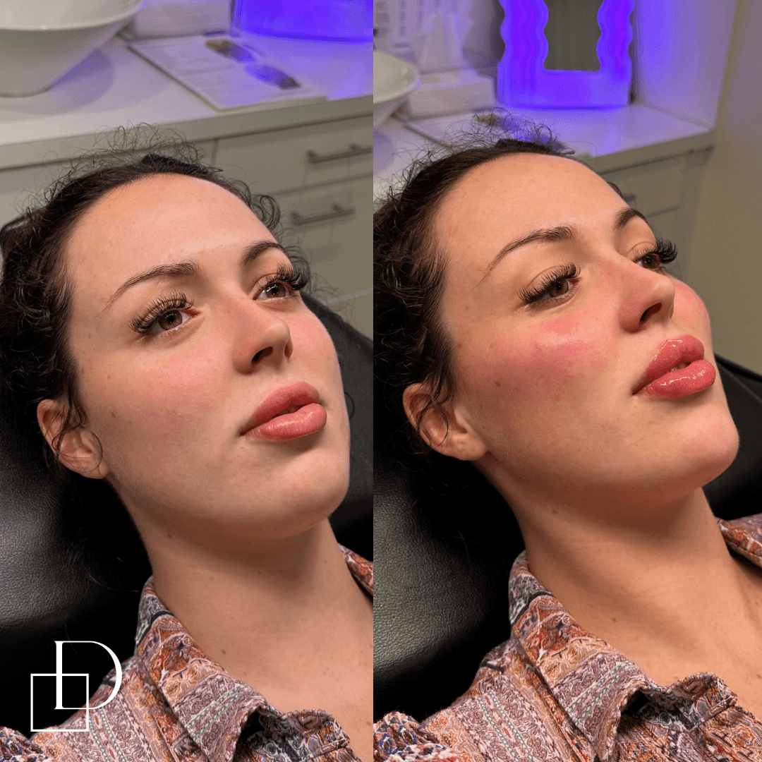 Before and after cosmetic dermal filler injections at Define Clinic Brisbane