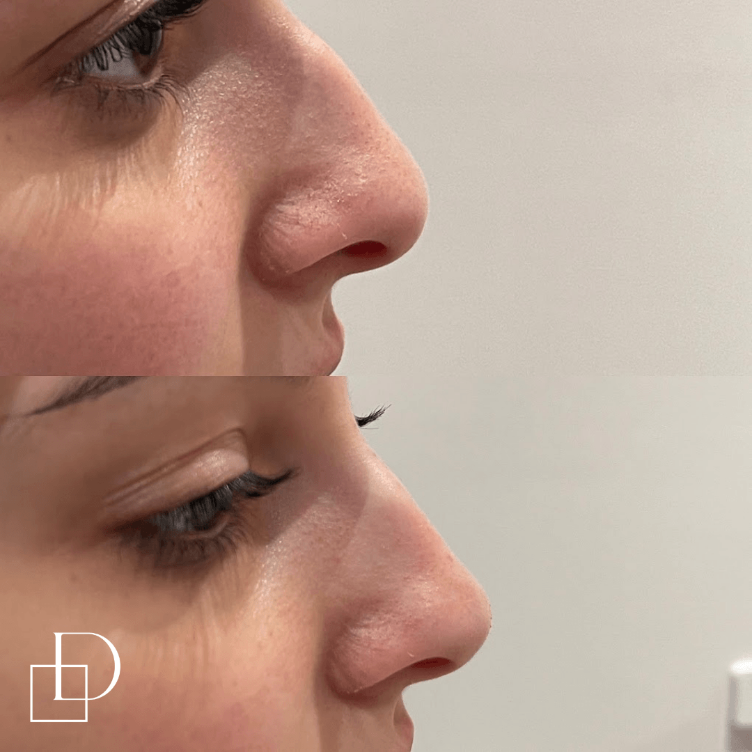 Before and after non-surgical rhinoplasty nose filler at Define Clinic Brisbane
