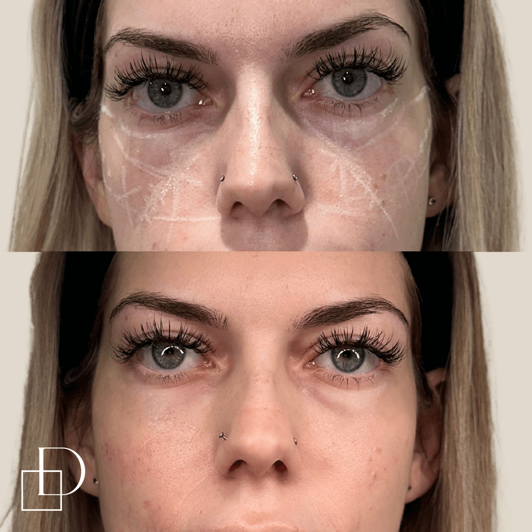 Before and after cheek filler injections at Define Clinic Brisbane