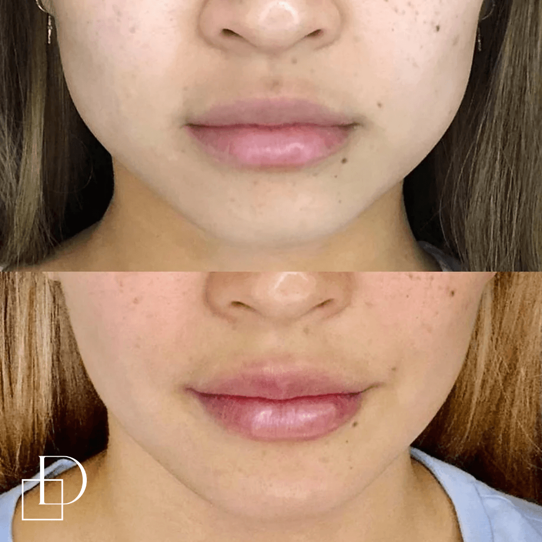 Before and after masseters TMJ botox at Define Clinic Brisbane