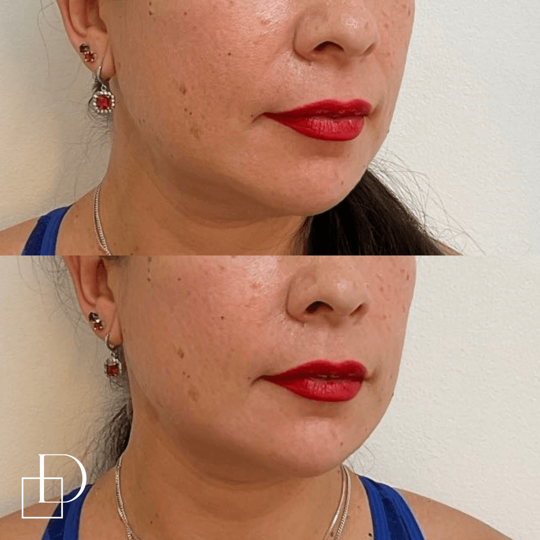 Before and after chin filler injections at Define Clinic Brisbane