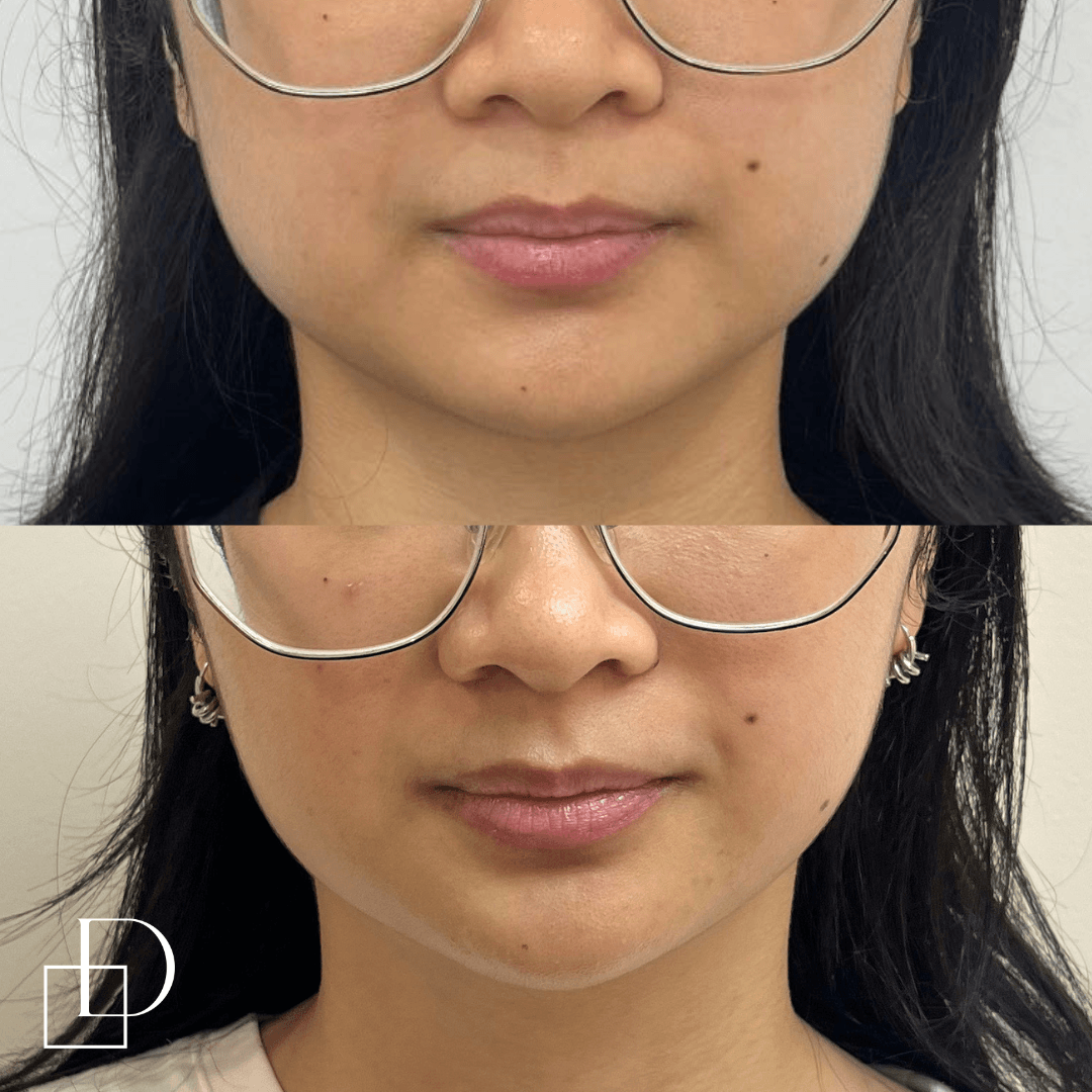 Before and after masseters botox at Define Clinic Brisbane