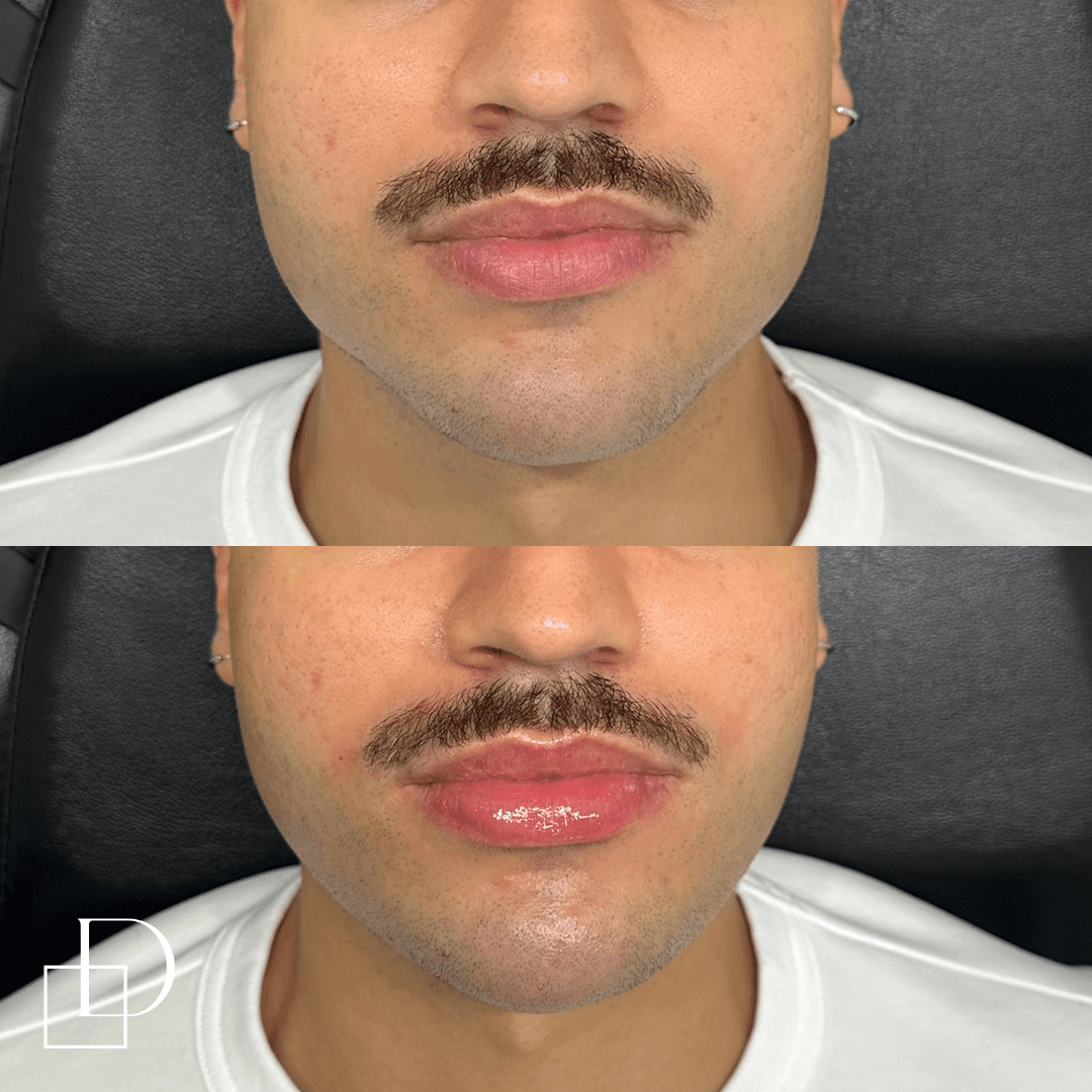 Before and after lip filler and chin injections on a male patient at Define Clinic Brisbane