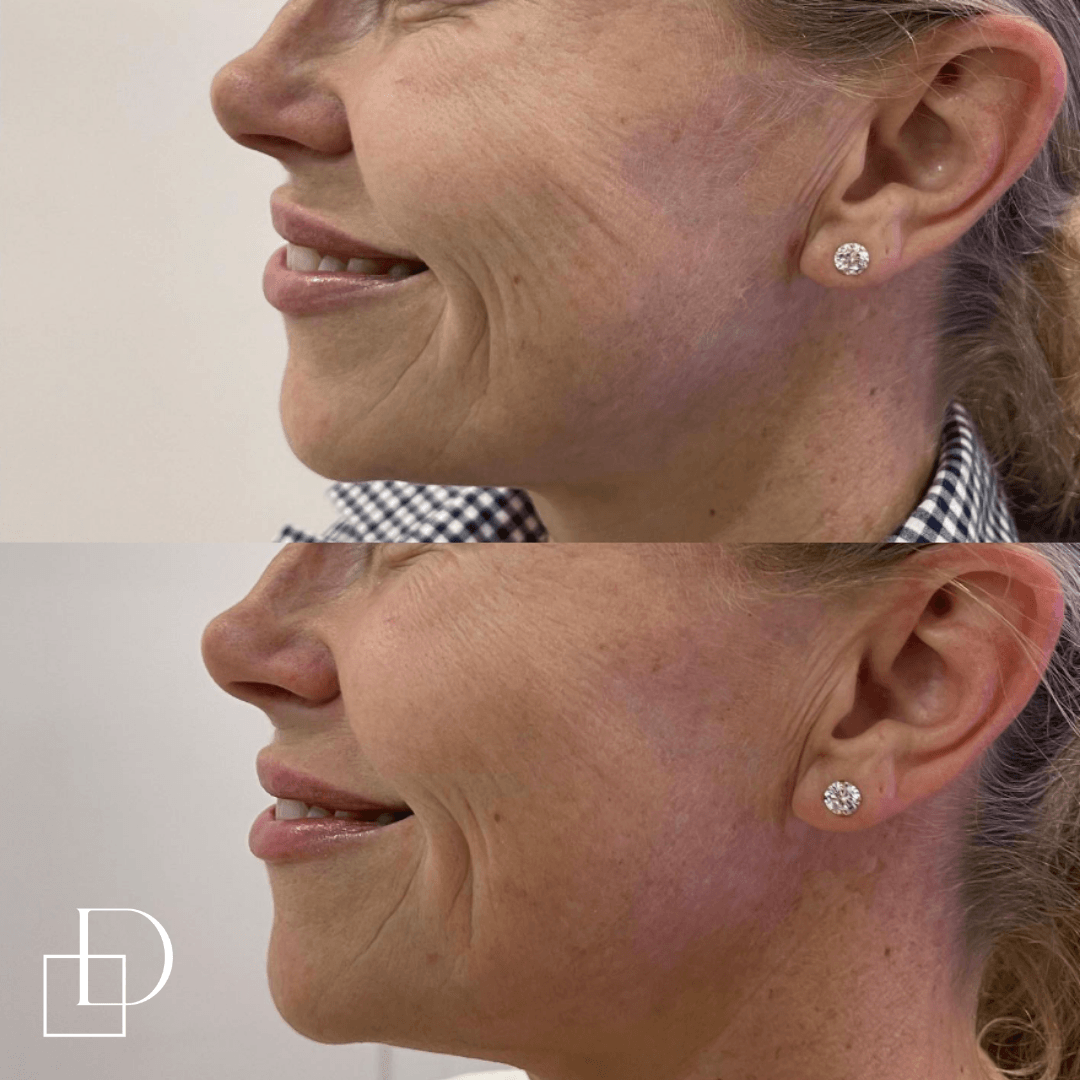 Before and after profhilo treatment