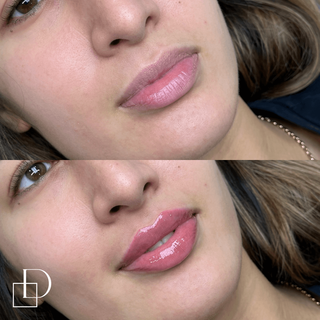 Before and after lip filler injections at Define Clinic Brisbane