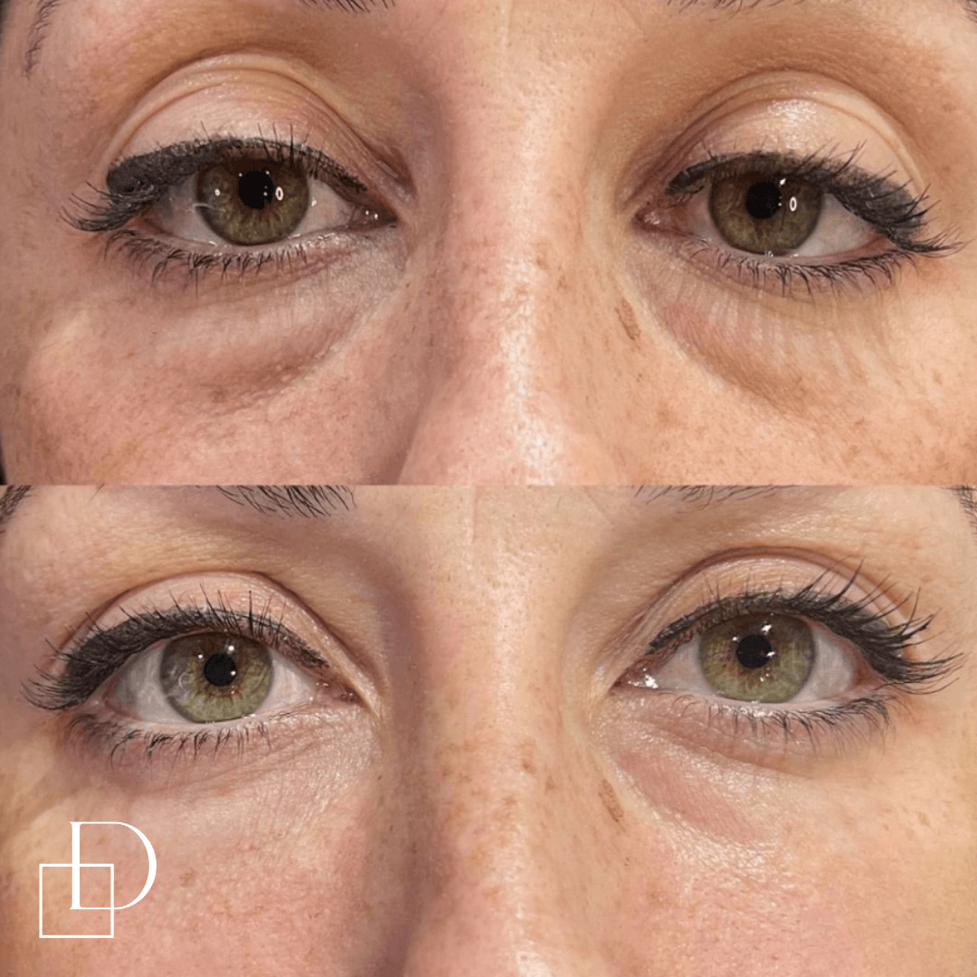 Before and after tear trough under eye filler injections at Define Clinic Brisbane
