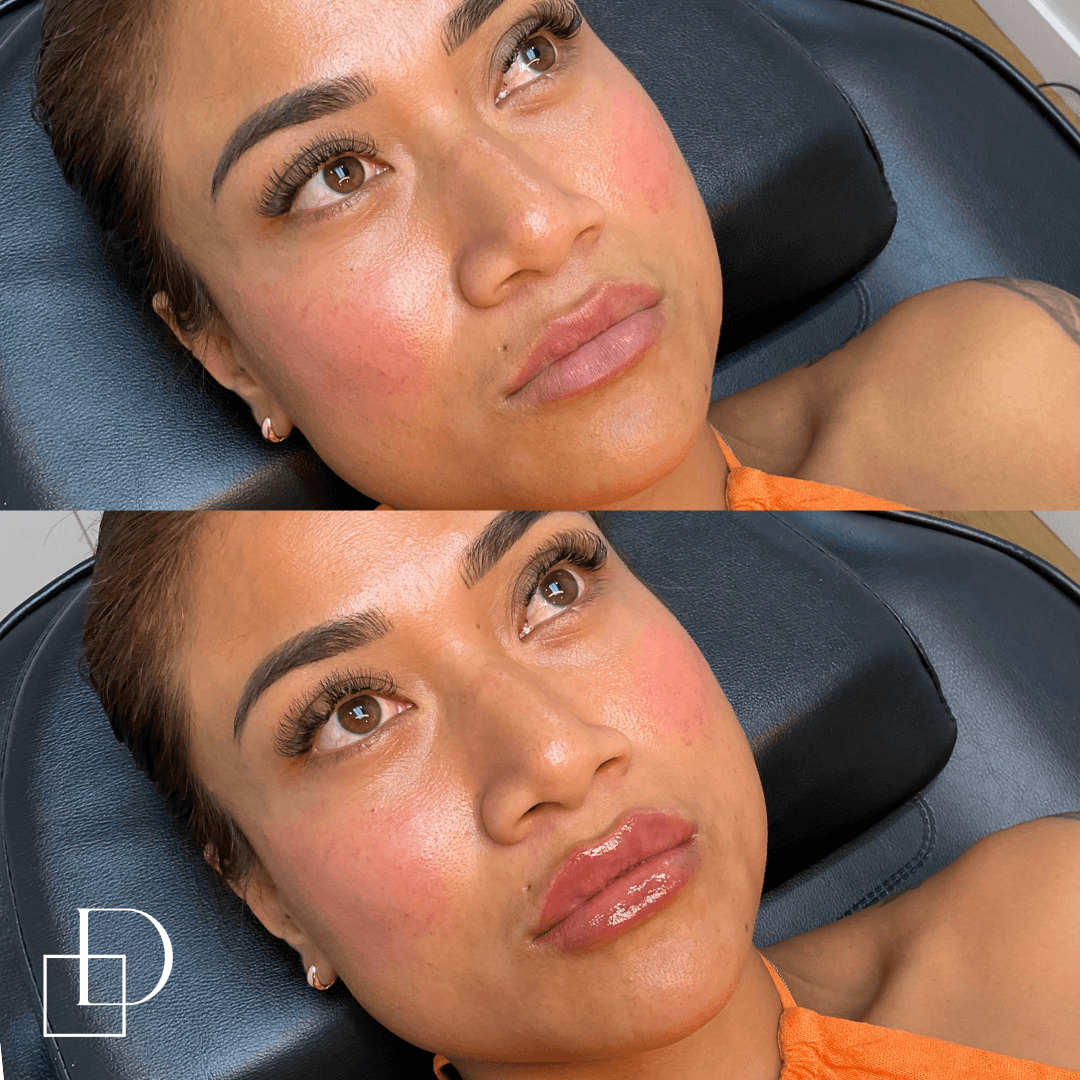 Before and after lip filler injections at Define Clinic Brisbane