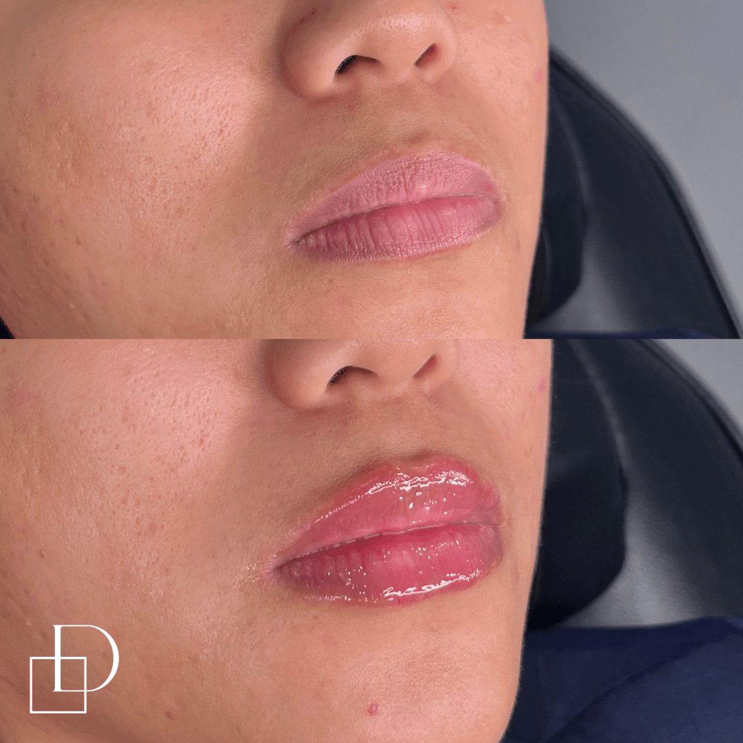 Before and after lip filler injections at Define Clinic Brisbane