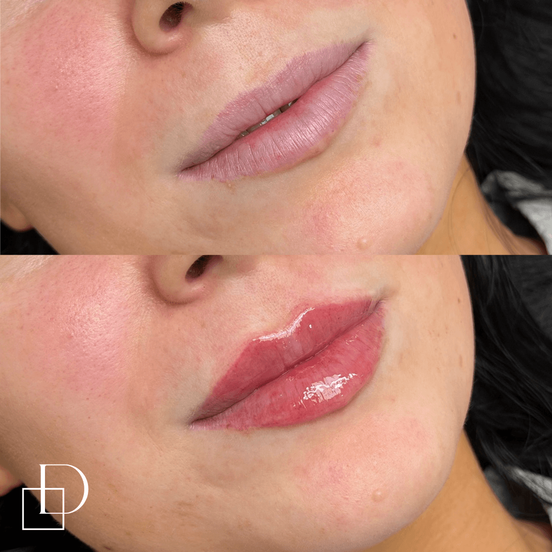 Before and after lip filler injections at Define Clinic Brisbane
