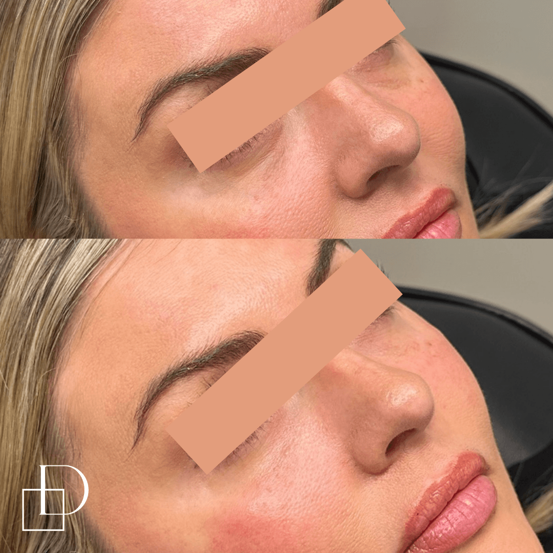 Before and after tear trough under eye filler injections at Define Clinic Brisbane
