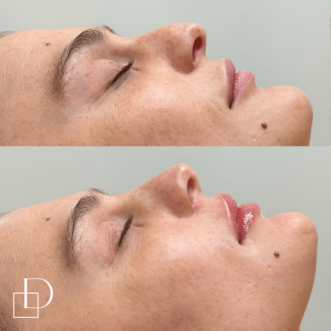 Before and after non-surgical rhinoplasty nose filler and lip filler at Define Clinic Brisbane